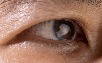 June is National Cataract Awareness Month