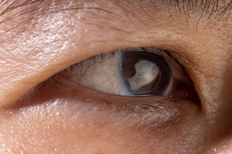 cataract-img