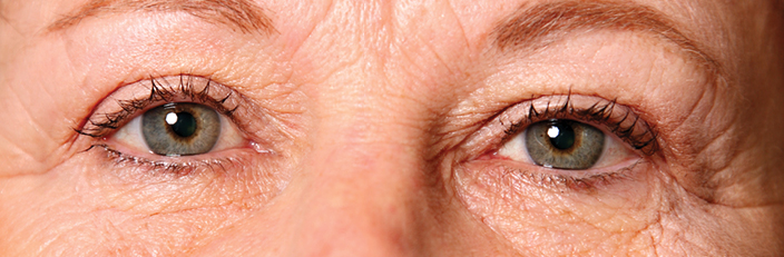 ESA Eyelid Rejuv 4