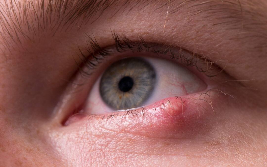 Is it a Chalazion or Stye?