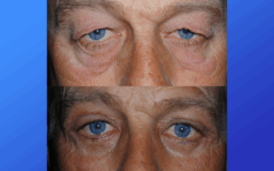 What’s causing your drooping eyelid will determine the treatment
