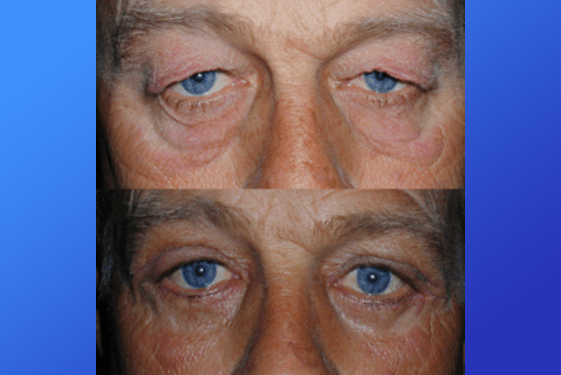 droopy-eyes-img