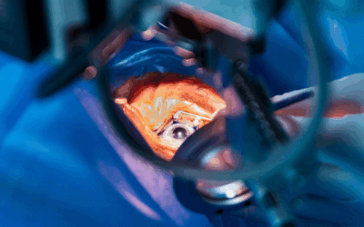 Cataract Surgery Can Reduce Or Eliminate Your Need For Glasses