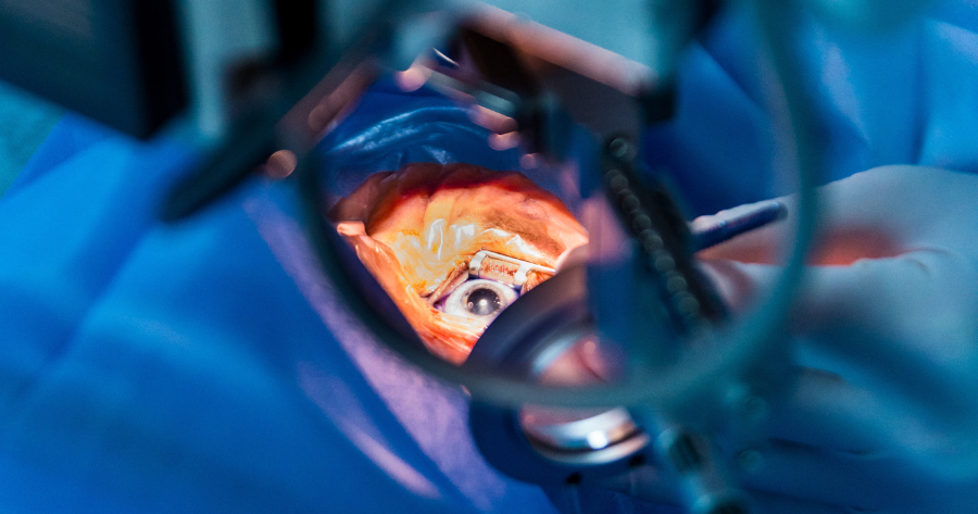 Cataract Surgery Can Reduce Or Eliminate Your Need For Glasses