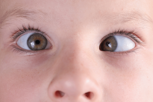 How Can Pediatric Strabismus Surgery Improve Your Child’s Vision?