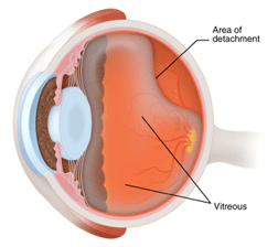 diagram Posterior vitreous detachment