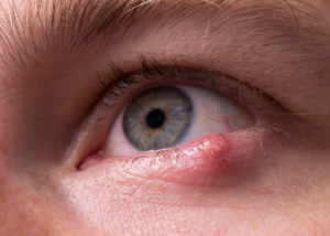 Lump discount inside eyelid