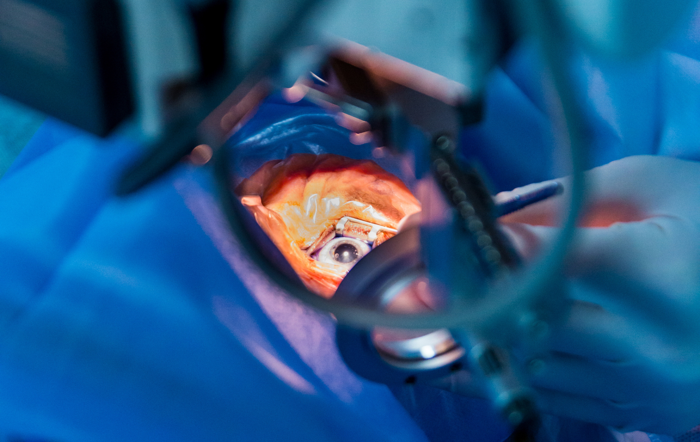 Understanding Cataracts and How Eye Surgeons Associates Can Help