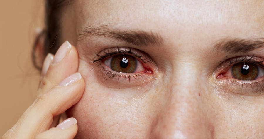 dry eyes