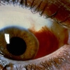 eye with blood around iris