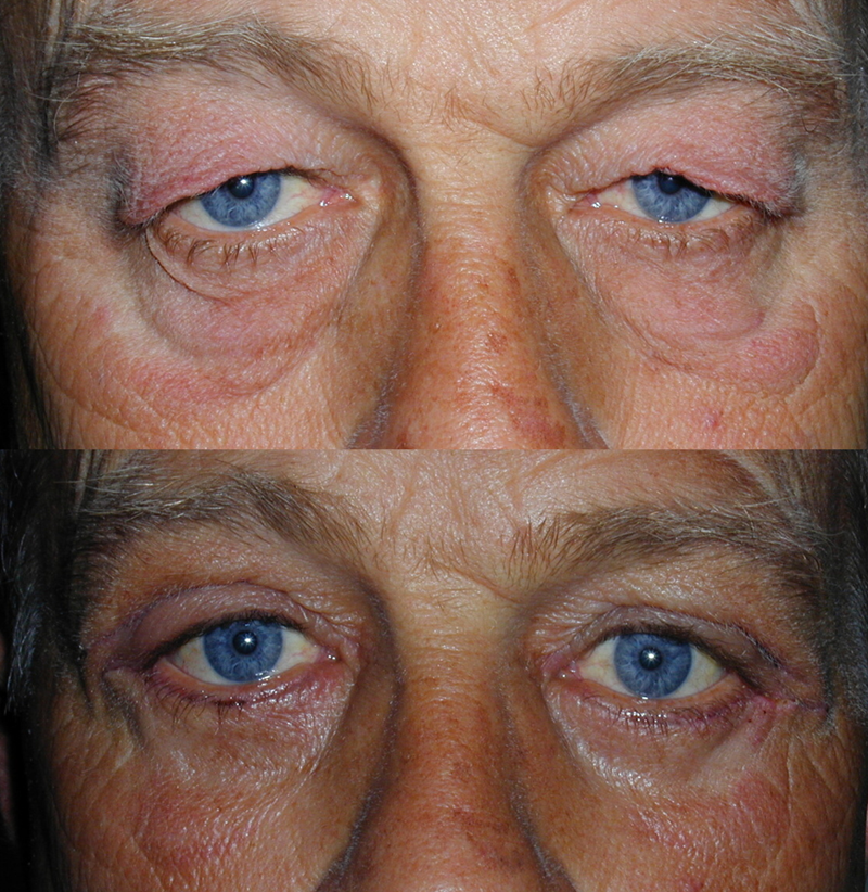 upper and lower eyelid blepharoplasty